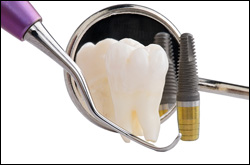 10.Dental-Implants