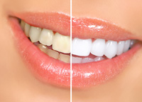 before and after results of professional teeth whitening Asheville, NC