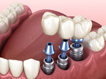 illustration of dental implants being assembled and installed into mouth, Asheville, NC dental implants